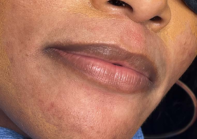 Before Lip Fillers procedure photo