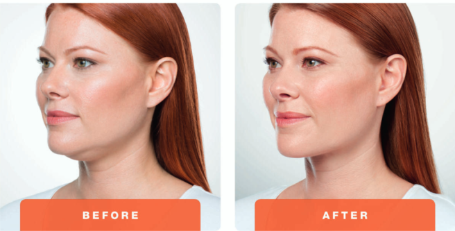 Double Chin Treatment Before & After Image
