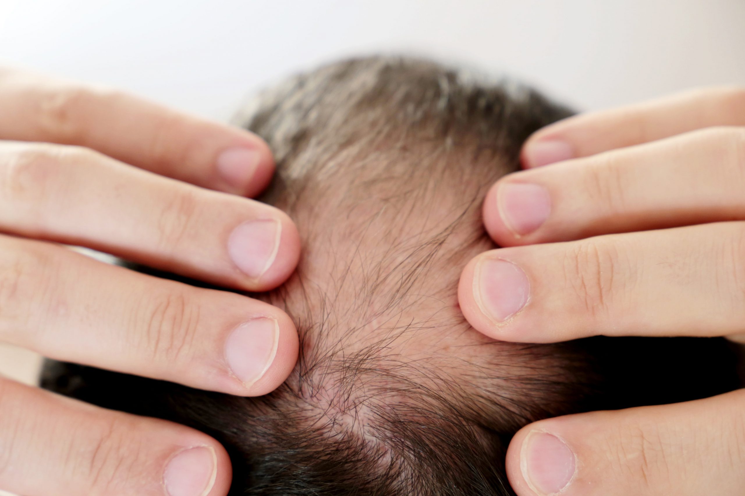 What Is PRF Hair Restoration?