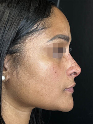 Liquid Rhinoplasty