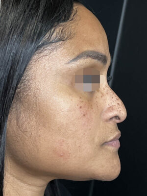 Liquid Rhinoplasty