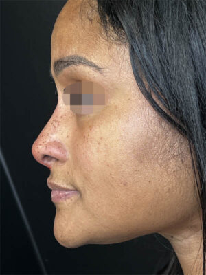 Liquid Rhinoplasty