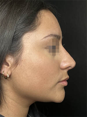 Liquid Rhinoplasty