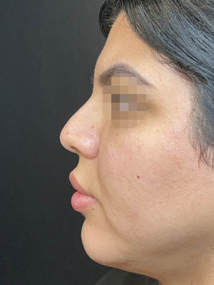 Liquid Rhinoplasty
