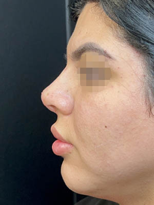 Liquid Rhinoplasty