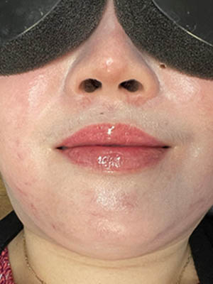 Lip Fillers