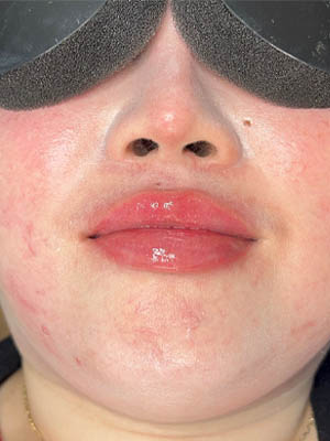 Lip Fillers