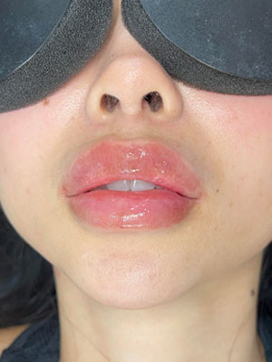Lip Fillers