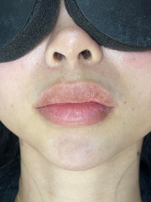 Lip Fillers