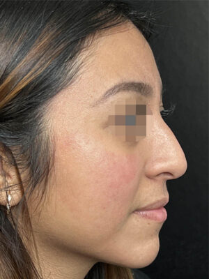 Liquid Rhinoplasty