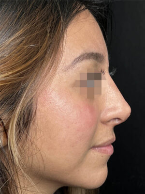 Liquid Rhinoplasty