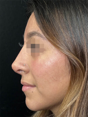 Liquid Rhinoplasty