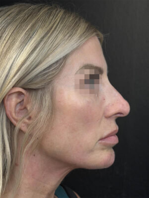 Liquid Rhinoplasty