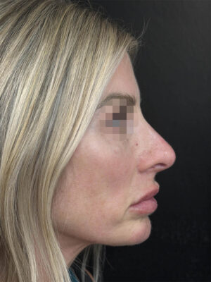 Liquid Rhinoplasty